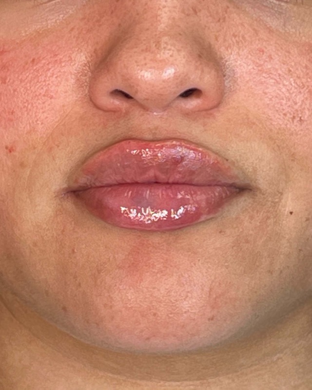 Juvederm Before & After Image