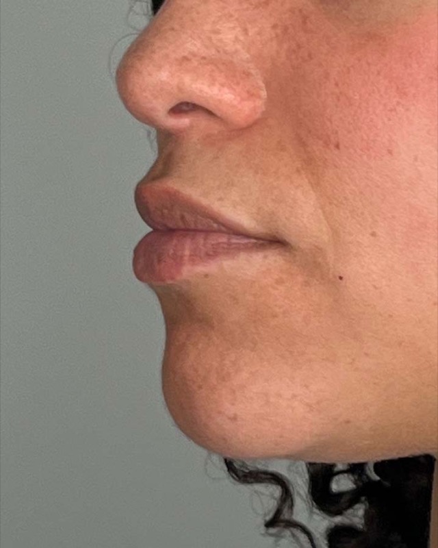 Juvederm Before & After Image