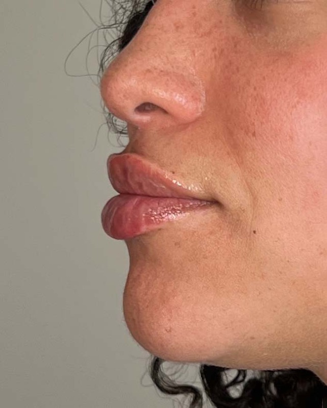 Juvederm Before & After Image