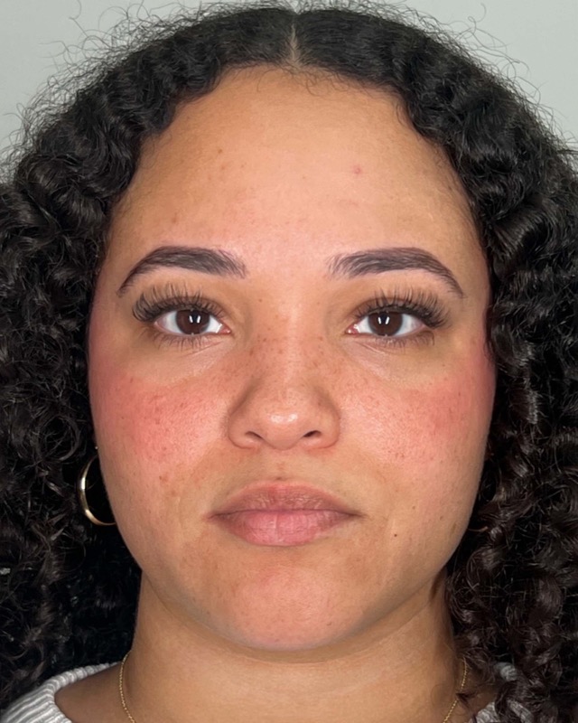 Juvederm Before & After Image