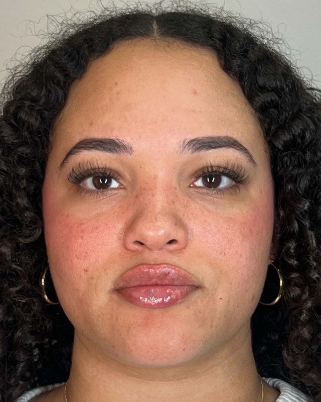 Juvederm Before & After Image