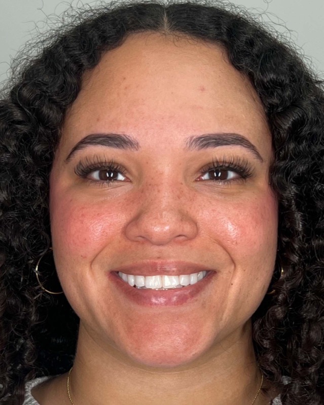 Juvederm Before & After Image