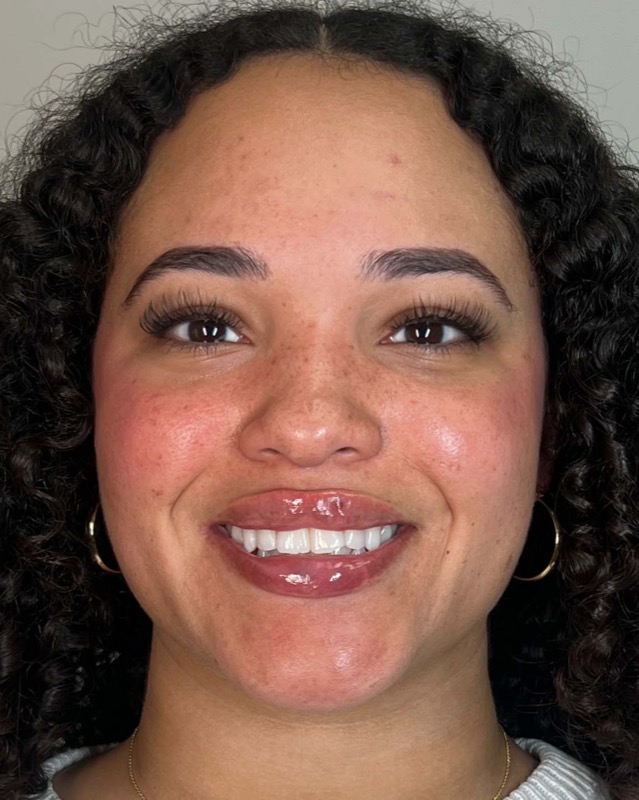 Juvederm Before & After Image