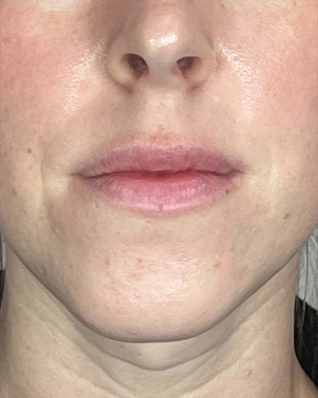 Juvederm Before & After Image