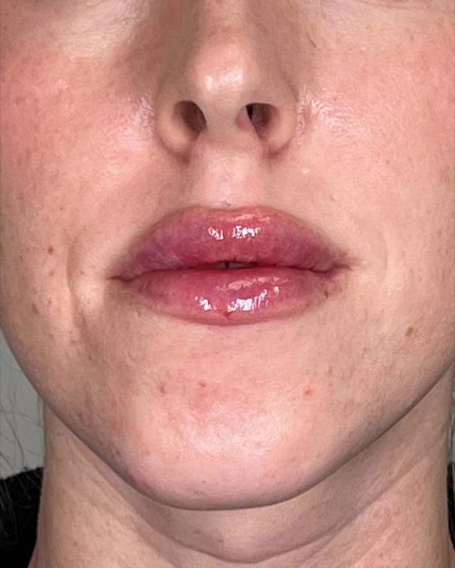 Juvederm Before & After Image