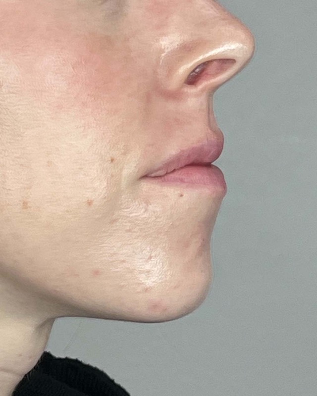 Juvederm Before & After Image