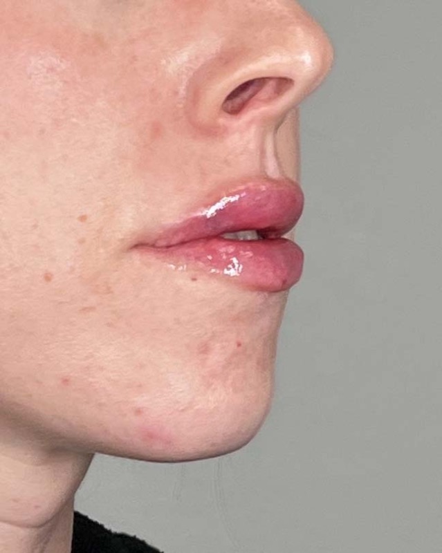 Juvederm Before & After Image