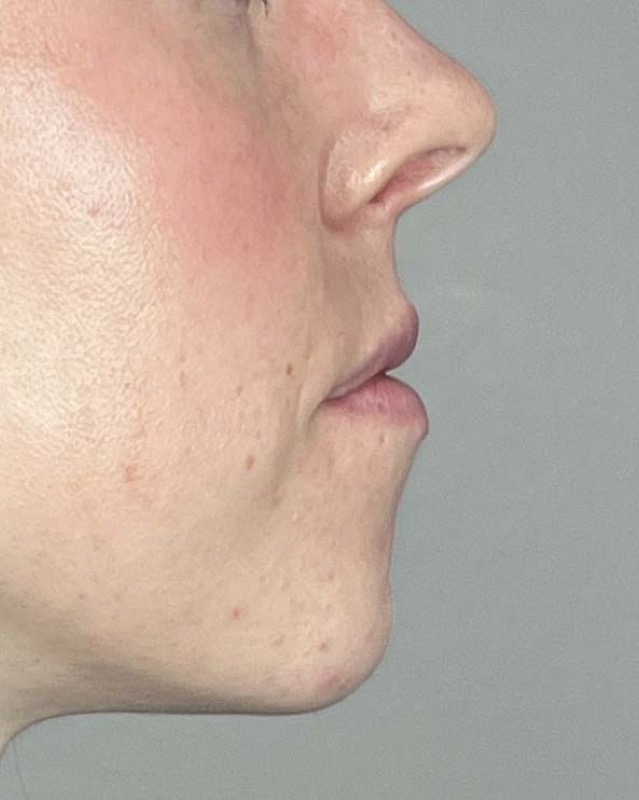 Juvederm Before & After Image
