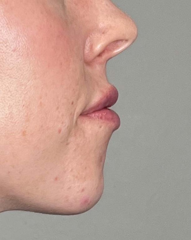 Juvederm Before & After Image