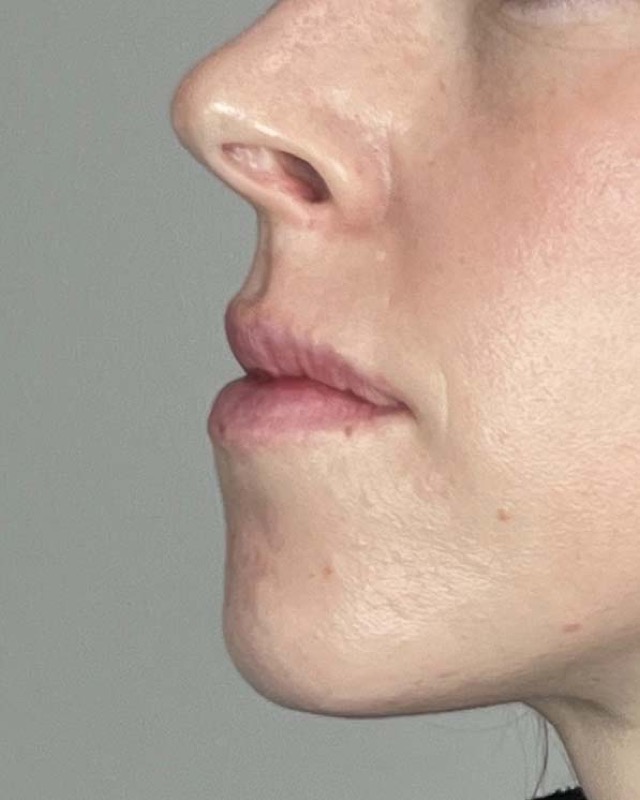 Juvederm Before & After Image