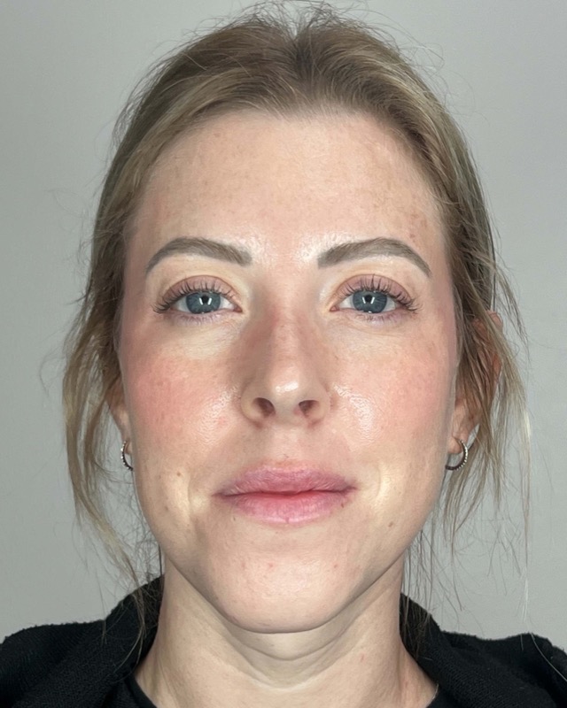 Juvederm Before & After Image