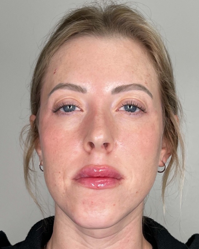 Juvederm Before & After Image
