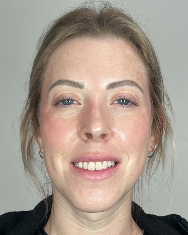 Juvederm Before & After Image