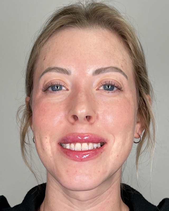 Juvederm Before & After Image