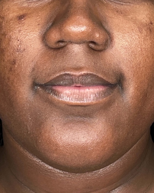 Juvederm Before & After Image