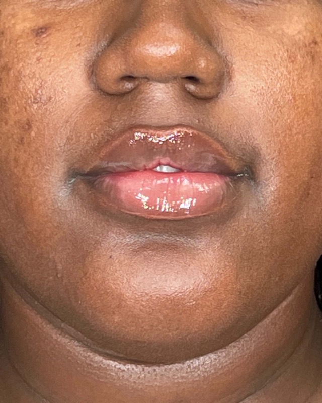 Juvederm Before & After Image