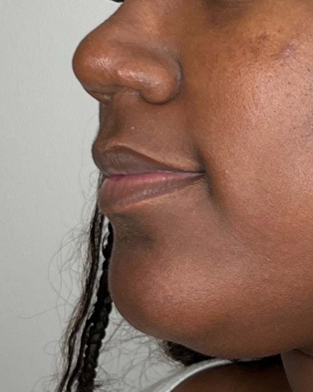 Juvederm Before & After Image