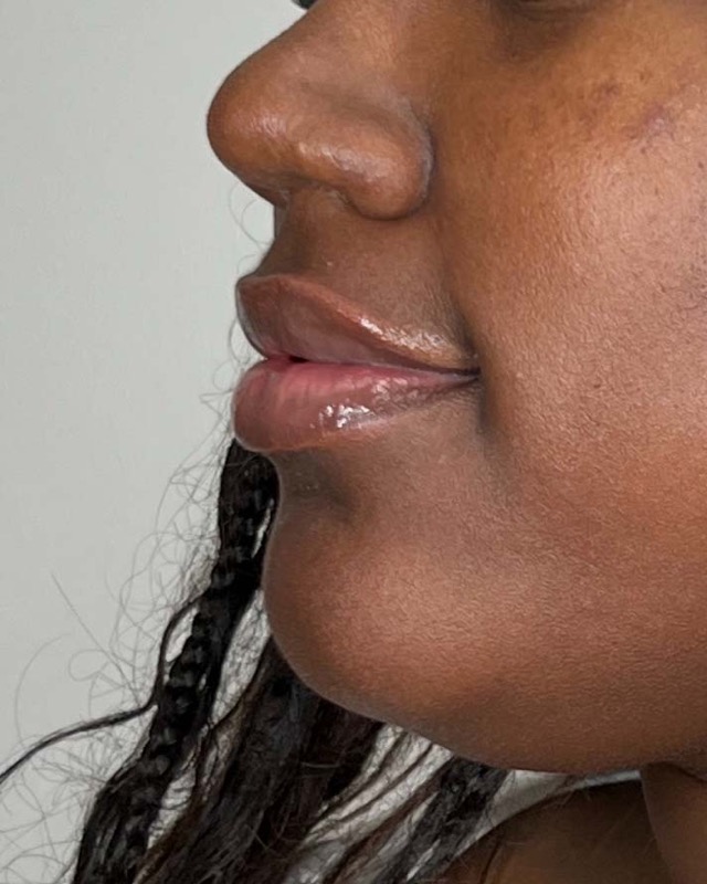 Juvederm Before & After Image