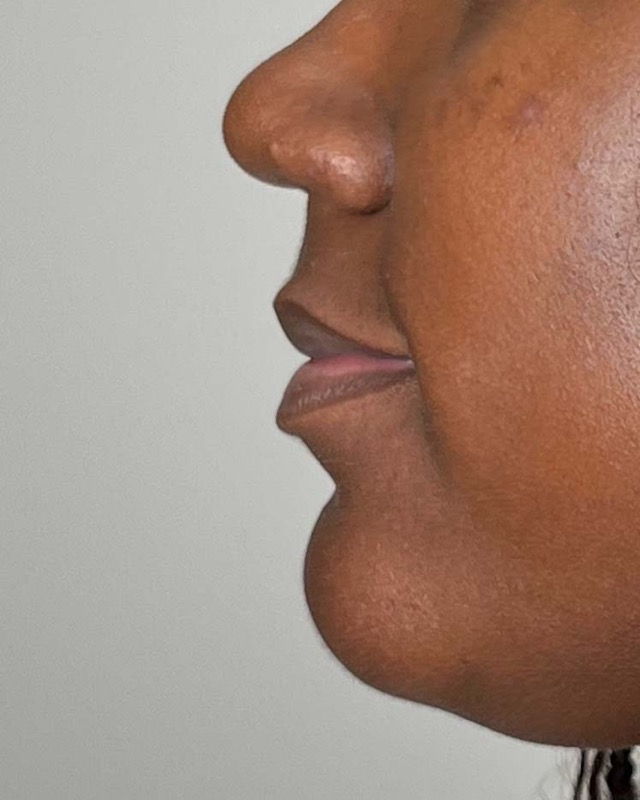 Juvederm Before & After Image