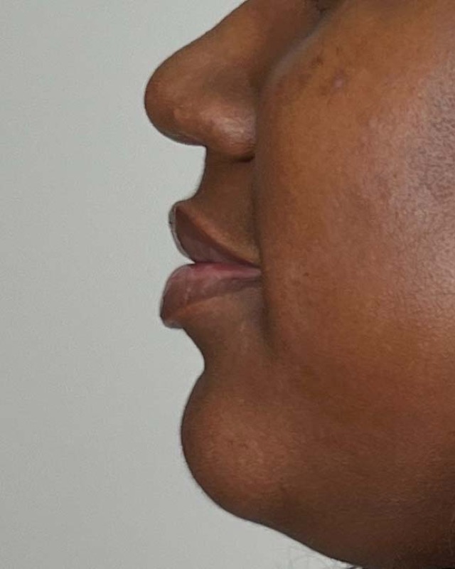 Juvederm Before & After Image