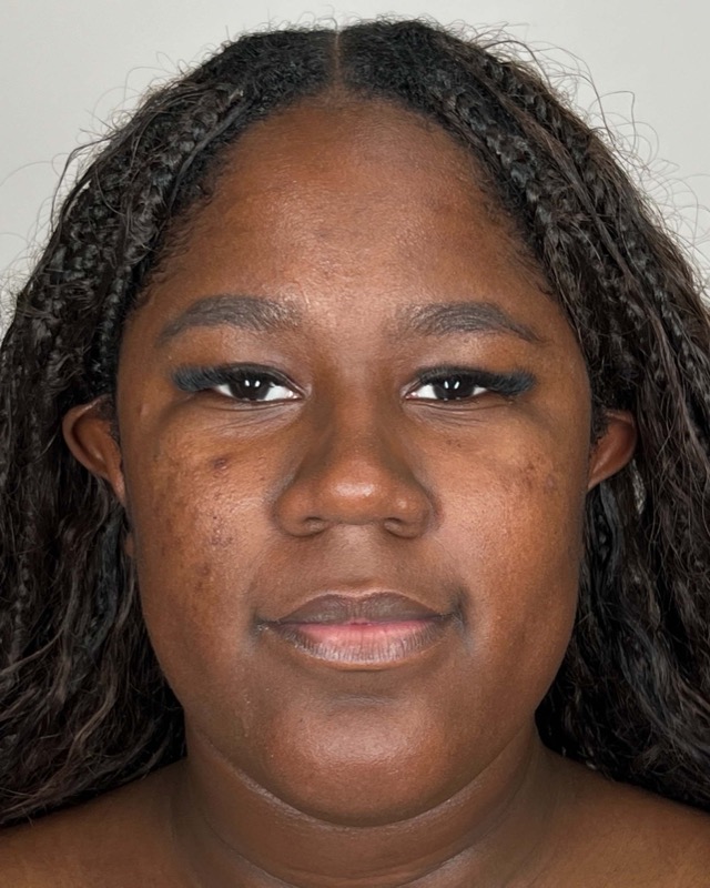 Juvederm Before & After Image