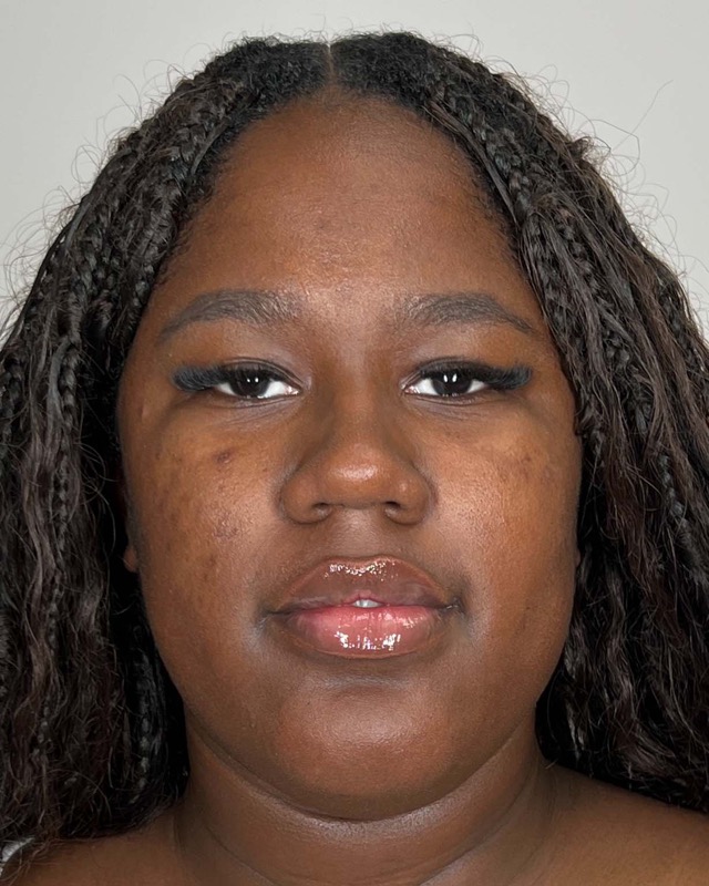 Juvederm Before & After Image