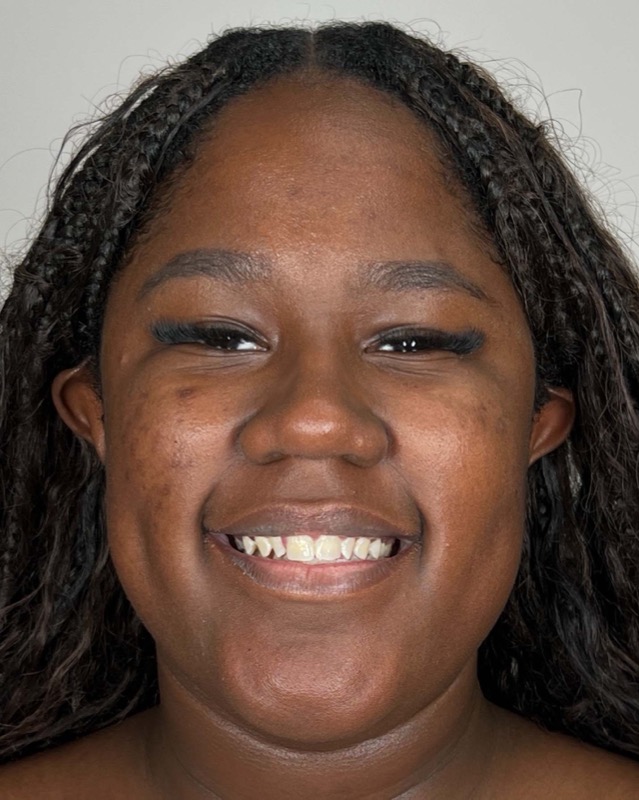 Juvederm Before & After Image