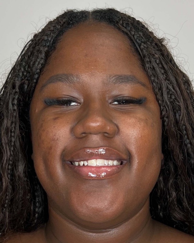 Juvederm Before & After Image