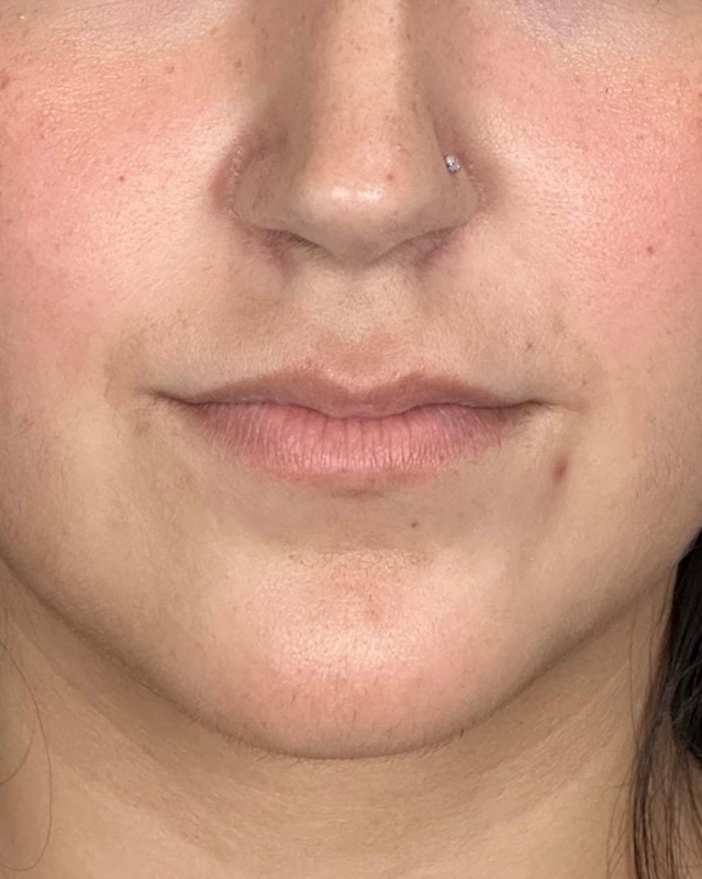 Juvederm Before & After Image