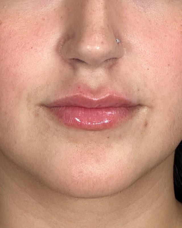Juvederm Before & After Image