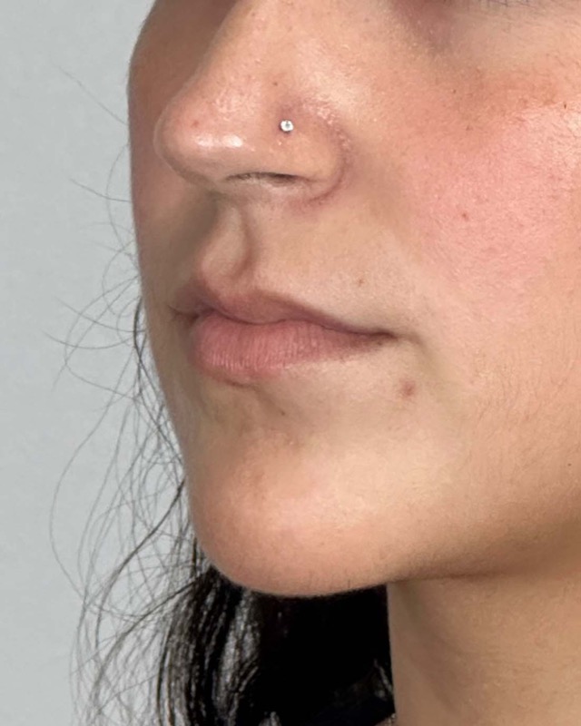 Juvederm Before & After Image