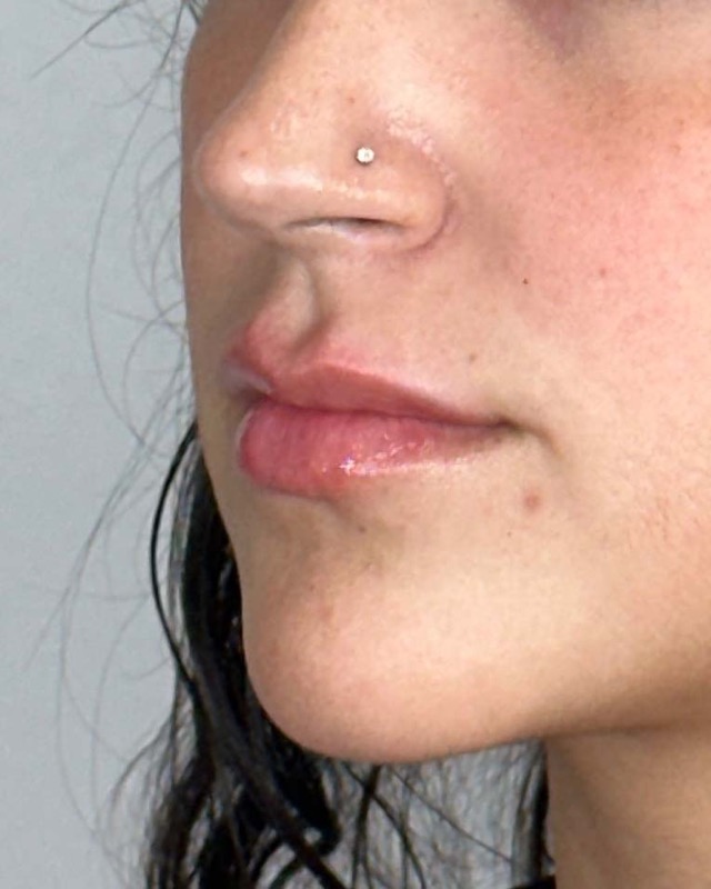 Juvederm Before & After Image