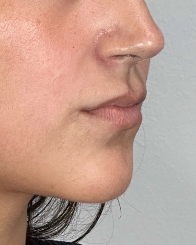 Juvederm Before & After Image