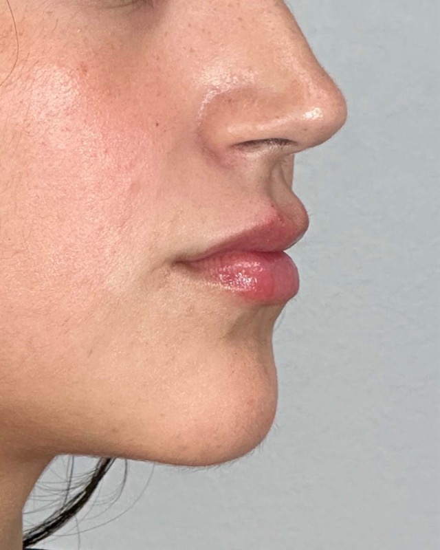 Juvederm Before & After Image