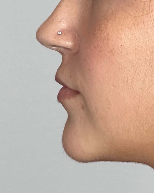 Juvederm Before & After Image