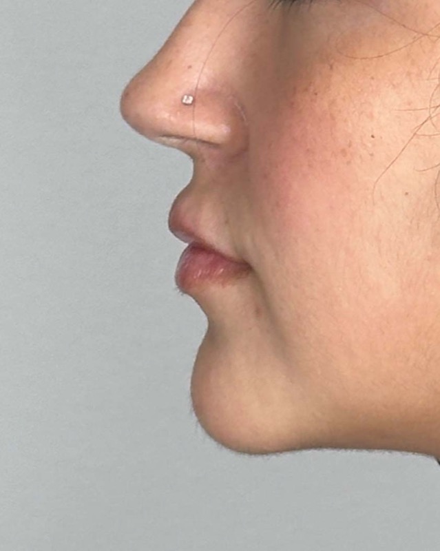 Juvederm Before & After Image