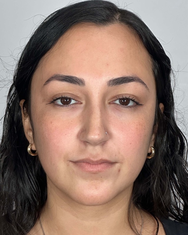 Juvederm Before & After Image