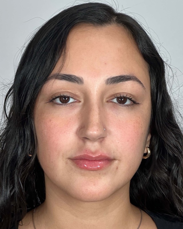 Juvederm Before & After Image