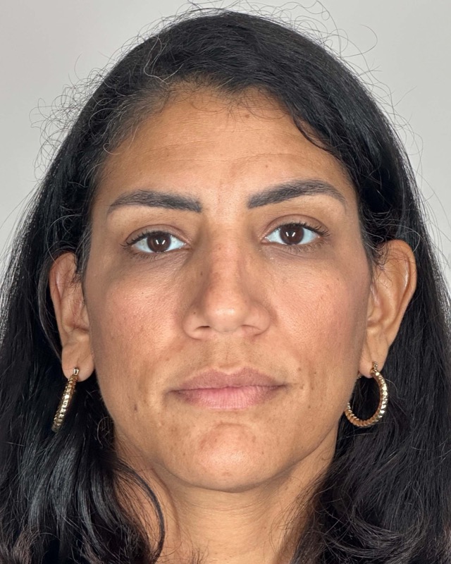 Juvederm Before & After Image