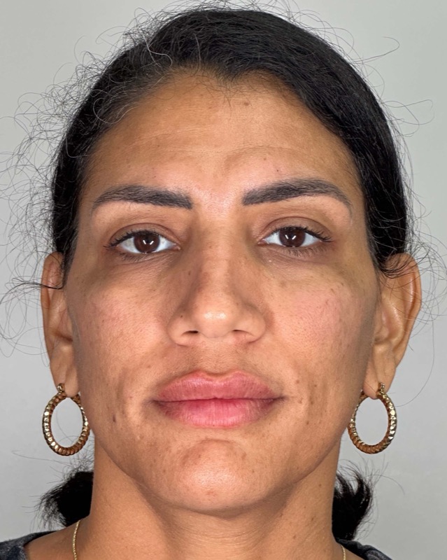 Juvederm Before & After Image
