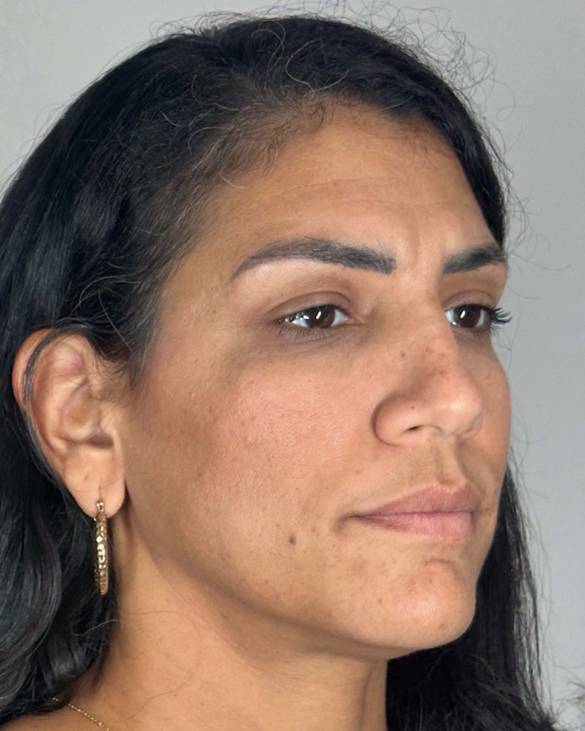 Juvederm Before & After Image