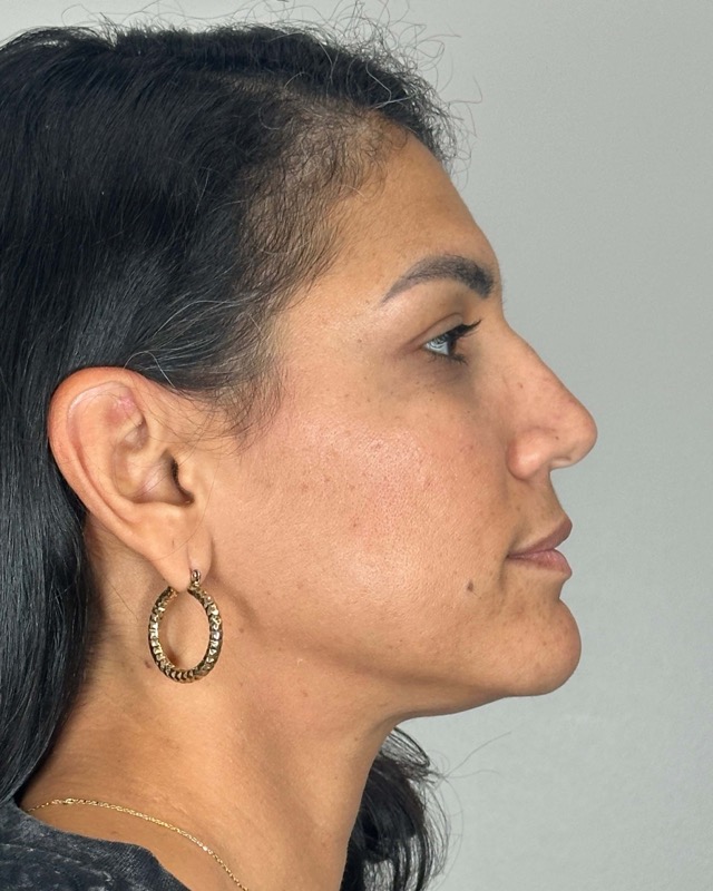 Juvederm Before & After Image