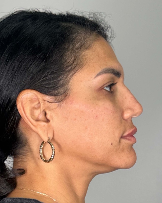 Juvederm Before & After Image
