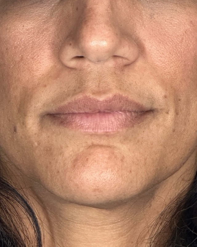 Juvederm Before & After Image