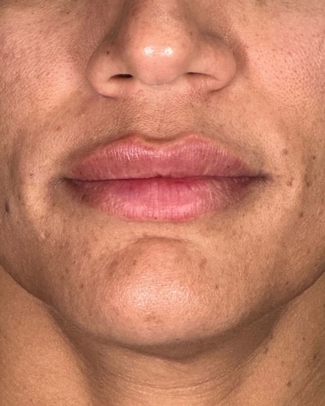 Juvederm Before & After Image