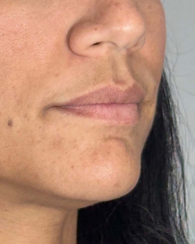 Juvederm Before & After Image