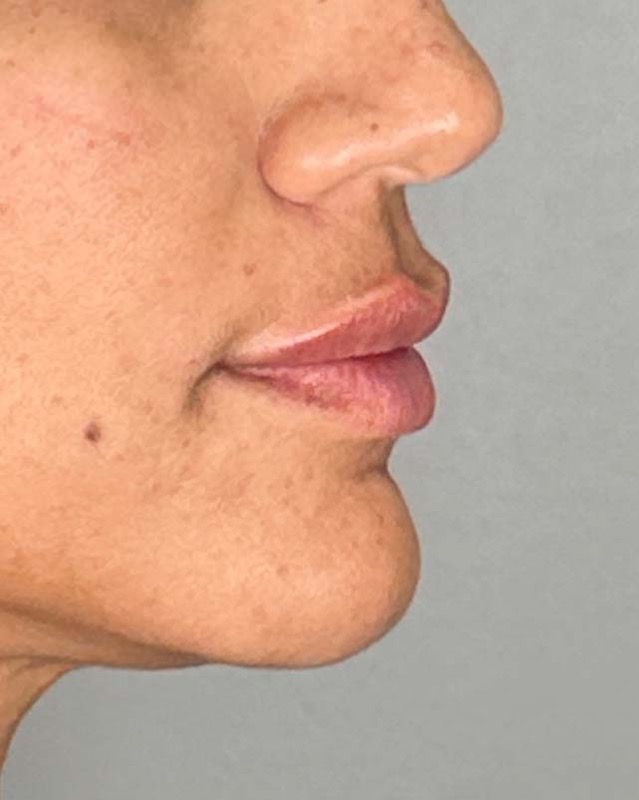 Juvederm Before & After Image