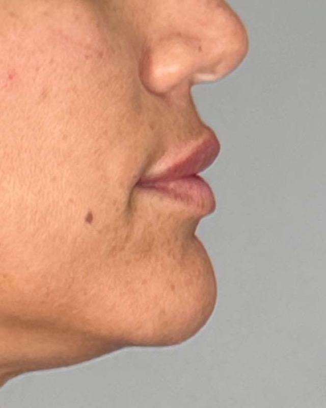 Juvederm Before & After Image