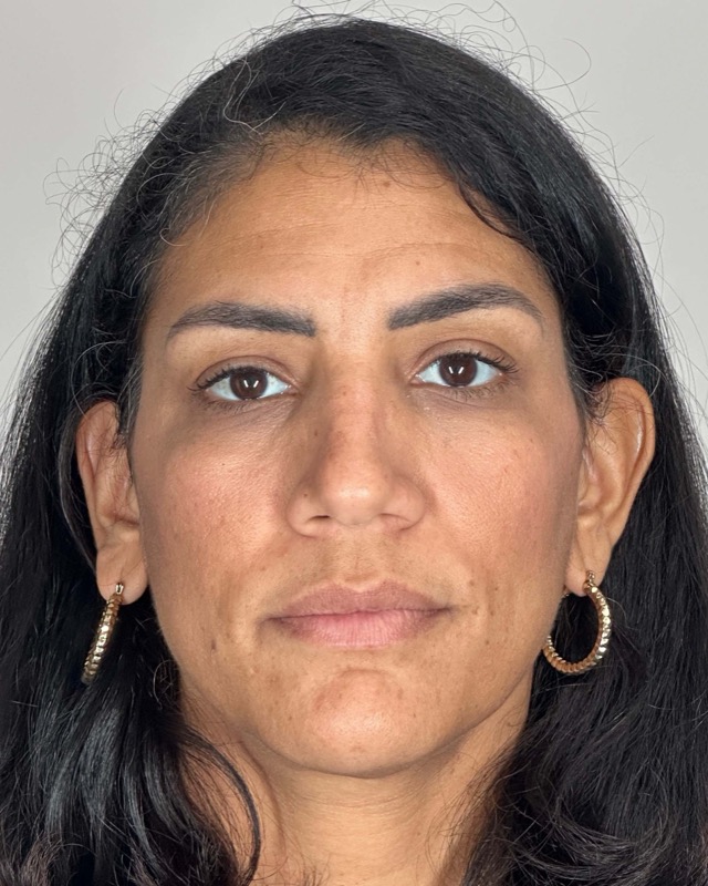 Juvederm Before & After Image