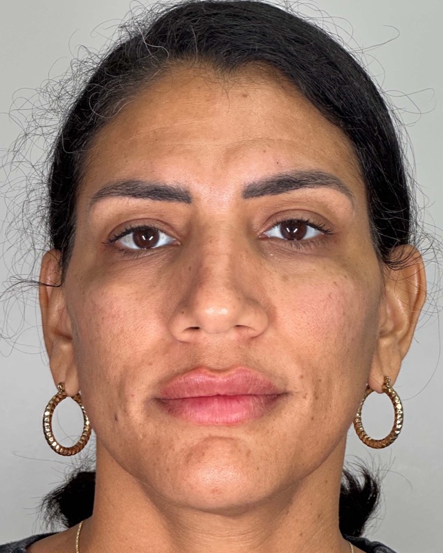 Juvederm Before & After Image